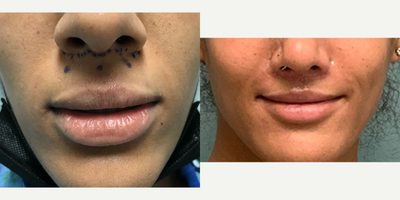18-24 year old gender nonconforming person treated with Forehead Reduction, Transgender Facial Feminization Surgery, Facial Femi - This is a young lady who underwent forehead reconstruction, septorhinoplasty, and mandible reduction, and adams apple reduction. Lip lift is 2 months post op.
