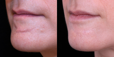 25-34 year old female scar removal with excision followed by dermabrasion and DeepFX laser resurfacing, - Excision followed by dermabrasion and DeepFX laser resurfacing, and vascular laser treatments.