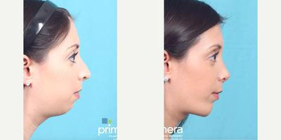 25-34 year old woman treated with Rhinoplasty, Cheek Implants, Chin Implant - This Orlando, FL woman was bothered by breathing issues, the dorsal hump on the bridge of her nose, a drooping nasal tip, her recessed chin, and excess skin under her chin. Dr. Gross recommended Rhinoplasty, Chin Implant, & Submentoplasty. to create harmony with her 3 main areas of concern: nose, chin, and jawline. Her nose now has a slight slope along the bridge with an upturned tip. The vertical lengthening chin implant (from Implantech) evens out the proportions of her face in profile, and the chin tuck (platysmaplasty) provides definition to her jawline and tightens the muscles in her neck. She couldn't be happier with her results!