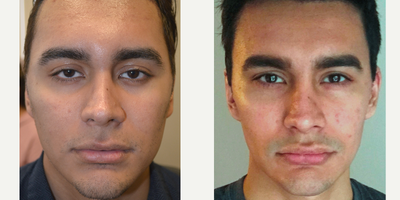 Young male underwent almond eye and droopy eyelid ptosis surgery. - 24 year old male, complained of looking sad and tired due to inherited lower eyelid retraction with negative canthal tilt and droopy upper eyelids (ptosis). He underwent almond eye surgery (lower eyelid retraction surgery using scar-less transconjunctival technique and canthoplasty) and upper eyelid ptosis repair. Before and 3 months after eye plastic surgery photos are shown.