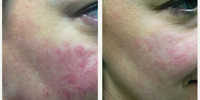 35-44 year old woman treated with Excel V - After 1 treatment.