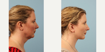 35-44 year old woman treated with Cheek Lift - A 43 year old woman before and after Cheek and Necklift w/Anterior Platysmaplasty by Andrew T. Lyos M.D., FACS. She was most bothered by her lower neck and jowling.