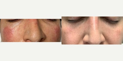35-44 year old woman treated with IPL - Patient was concerned with dark spots from previous sun exposure/damage. Her result is diminished appearance of excess pigmentation, along with smoother surface and radiance skin
