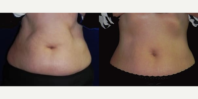 Woman treated with Vanquish - Woman treated with Vanquish.