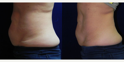 60 year old woman treated with Vanquish - 60 year old woman treated with Vanquish.
