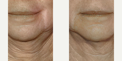 Woman treated with Profound RF - Woman treated with Profound RF