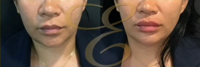 Woman treated with Botox, Lip Fillers - Woman treated with Botox, Lip Fillers
