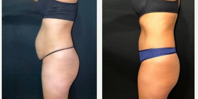35-44 year old woman treated with Tummy Tuck, Umbilical Hernia Repair - The patient is a 39-year-old female who had concerns with her abdominal pannus and umbilical hernia after having children. The procedure performed was an abdominoplasty with umbilical hernia repair. The photos show 15 months post-op.