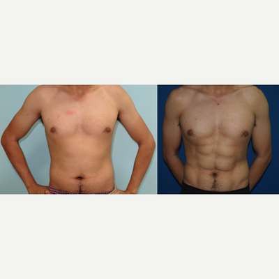25-34 year old man treated with Abdominal Etching - Male patient 3 months after high-definition liposuction to create more muscular six-pack.