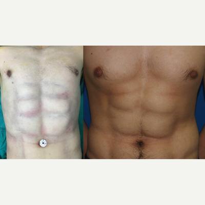 25-34 year old man treated with Abdominal Etching - Male patient immediately after surgery and three months after high-definition liposuction to create more muscular six-pack.