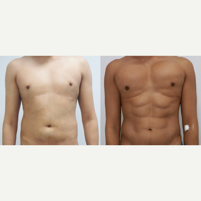 35-44 year old man treated with Abdominal Etching - 3 months after post-op abdominal etching