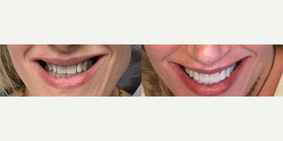 Woman treated with Lumineers - Woman treated with Lumineers.
