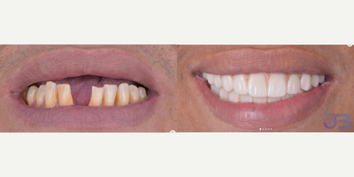 Man treated with Dental Bridge, All-on-4 Dental Implants - Top: All on X zirconium OverdentureBottom: Zirconium Dental Bridge