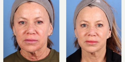 63 year old woman treated with Facelift, BroadBand Light (BBL) - 3 months after in-office facelift and BBL