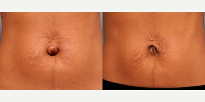 Belly Button Surgery - This is a 24 year old woman who had a baby and says that her belly button never looked the same since.  She had some stretch marks, but was not ready for a tummy tuck.  I should add that at her age, and with such a slender physique I really didn't want to do a tummy tuck anyway.

We decided to perform umbilicoplasty, that is cosmetic surgery for the belly button, in the office under local anesthesia.  After re-arranging the tissues of the umbilicus a few times, I think I was able to create an innie belly button.