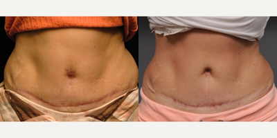 Belly Button Surgery - This is a 40 year old woman who had a tummy tuck done elsewhere and lost her belly button.  That is, it seemed not to survive the operation and she was left with a rather flat scar in the middle of her abdomen. &nbsp;I decided to attempt reconstruction using a few different basic plastic surgery tricks - nothing too fancy, but they worked out well.  She now has a somewhat natural appearing completely reconstructed belly button (neo-umbilicus).&nbsp;