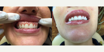 25-34 year old woman treated with Dental Crown - Patient received 10 anterior porcelain crowns (Emax).  Patient wanted whiter teeth and longer, more prominent canine teeth.