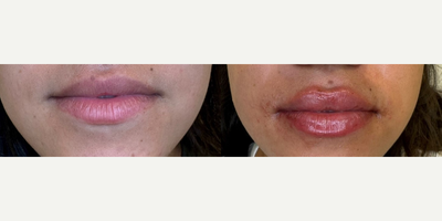 Woman treated with RHA Collection Fillers - Lip filler treatment w/ RHA