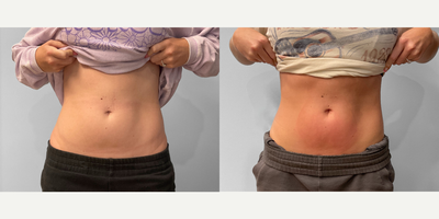 25-34 year old woman treated with Emsculpt - A woman in her mid-twenties wanted to tighten and tone her core using Emsculpt NEO. She initially scheduled 4 sessions but was so pleased with the results that she opted for a package of 6 treatments. The photos show the difference between her first treatment and her sixth. You can see that her muscles have tightened during this time frame, and she can expect further fat breakdown and results within the next 30-90 days.