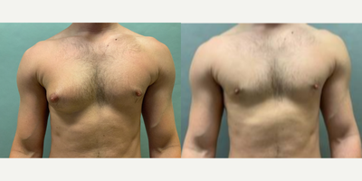 Man treated with Gynecomastia Surgery - Man treated with Gynecomastia Surgery