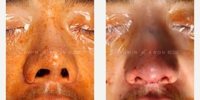 25-34 year old man treated with Asian Rhinoplasty, Revision Rhinoplasty, Rhinoplasty - 25-34 year old man treated with revision rhinoplasty. Patient had undergone primary rhinoplasty 5 years ago at another practice. He was not satisfied with the appearance of his nose as the columella began to deviate to the left, making his nasal tip appear not straight.  This also caused a significant degree of nostril asymmetry. He also felt that his nose appeared too upturned and did not fit his face. He underwent a revision rhinoplasty with extensive reconstruction of the nasal tip complex. The previous columellar strut rib graft was found to be severely deviated, which was replaced with bilateral extended septal extension grafts. The lower lateral cartilages required complete separation from the mucosa in order to be able to rotate or downturn the nasal tip to decrease the nostril show. The straight profile nasal bridge profile was maintained and the tip refinement was maintained with a nasal cap conchal cartilage graft. Overall, the nose appeared more masculine, symmetric, and straighter.