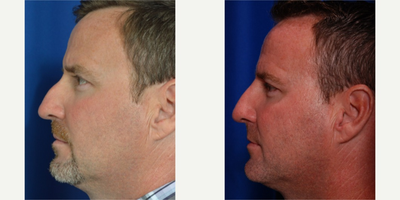 35-44 year old man treated with Non Surgical Nose Job - liquid rhinoplasty using HA filling agent