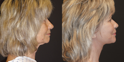 55-64 year old woman treated with Facelift - QuickLift (Facelift) Neck Extension, Neck Liposuction, Fat Transfer: Perioral and Cheeks, Chemical Peel, Subperiosteal Brow Lift, Lower Blepharoplasty