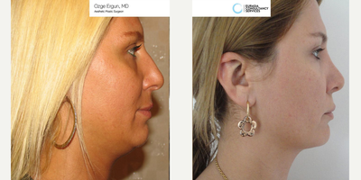 35-44 year old woman treated with Chin Liposuction - Jowl - Chin Liposuction