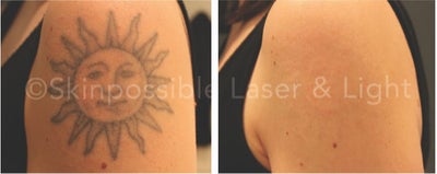 25-34 year old woman treated with PicoSure - The client wanted to remove her tattoo, we did a series of 6 picosure laser tattoo removal treatments!