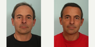 55-64 year old nonbinary person treated with Hair Transplant - 8 months post hair transplant.