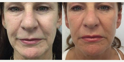 55-64 year old woman treated with Sofwave - A 57 year old patient who had combination Ultherapy 3mm. deep and Sofwave superficially on the cheeks 5 months ago