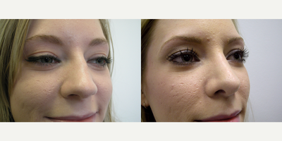 Woman treated with Rhinoplasty - Woman treated with Rhinoplasty
