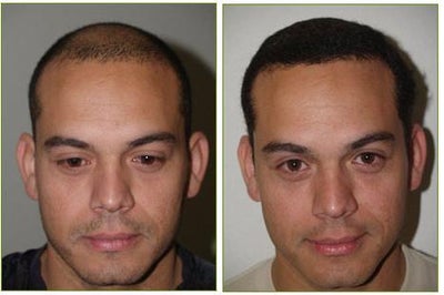 Hair transplant - FUE hair transplant - 3200 grafts