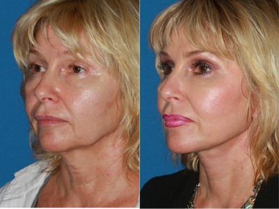 55-64 year old woman treated with Facelift - This patient presented with complaints of facial aging. Her primary concerns were sagging cheeks, significant jowls, and neck skin laxity. She also felt that her eyes appear tired. Face and neck lift and upper blepharoplasty was performed. Significant facial rejuvenation was achieved with removal of sagging neck skin, restoring smooth jawline and elevating midface. The eyes appear larger and youthful with removal of excess eyelid skin.