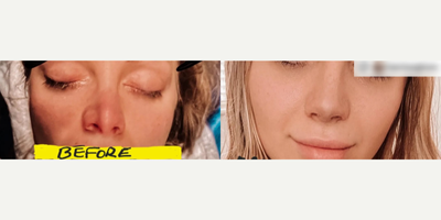 Woman treated with Revision Rhinoplasty - Woman treated with Revision Rhinoplasty, shown immediately after the surgery.