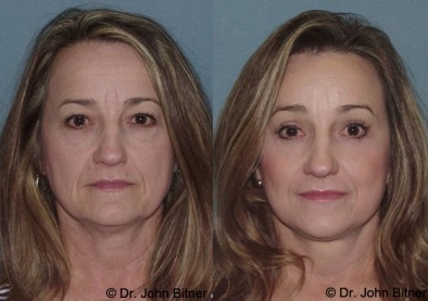 Laser Skin Resurfacing - 
	Laser Skin Resurfacing
