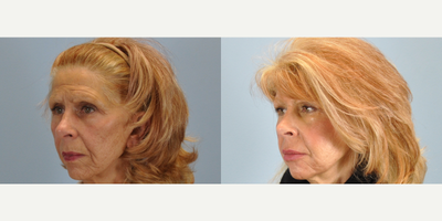 64 year old woman treated with Facial Fat Transfer - This 64 year old patient was concerned about the lack of volume around her lips, cheeks, and peri-oral area. She chose to undergo an autologous fat transfer to her face and lips, and is very happy with her result.