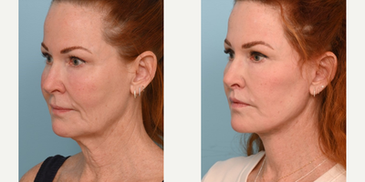 Woman treated with Facelift - This patient came to us bothered by her jowls and just wanted them lifted to redefine her jawline. She is a perfect example of how Dr. Balikians method of a deep plane facelift and deep neck lift can unveil your natural beauty without looking like a different person. She has such natural beauty to her face that combining an extended deep plane face and neck lift with conservative fat transfer and targeted laser resurfacing, unveiled those beautiful features without creating a done look.