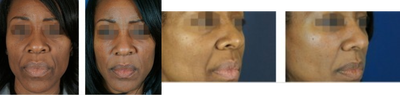 Fillers To Cheeks - Patient underwent facial filler injections to the cheeks to correct smile lines around the mouth.