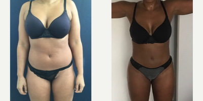 25-34 year old woman treated with Liposuction - Amazing post op results in this 32 year old patient from New York two months after 360 liposuction and Brazilian butt lift with Premium Care. Surgical time was minimized using two plastic surgeons, and she spent 10 days after surgery recovering in Cartagena at our five star Recovery Suites. Her figure looks amazing!