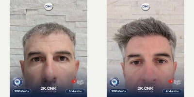 45-54 year old man treated with Hair Transplant, DHI Hair Transplant - 3550 grafts, 12 months DHI hair transplant