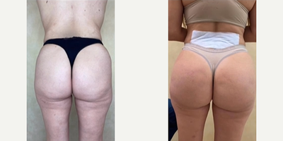 Woman treated with Butt Implants - Woman treated with Butt Implants- 6 months post-op