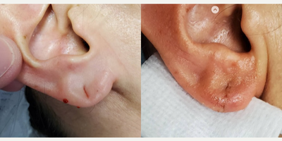 Woman treated with Earlobe Repair - Earlobe repair. Although this appears to be a small procedure, it improves quality of life for many patients. This delucate in-office procedure can usually be completed in under an hour with local anesthesia. Down time is minimal and the earlobe can be re-pierced in 8 to 12 weeks. Repair techniques differ based on the gauge size or degree of stretch the ear lobe has suffered. In this patient, only one side was repaired. This patient stated this lobe had stretched due to heavy ear rings, and she could no longer wear stud type ear rings. 