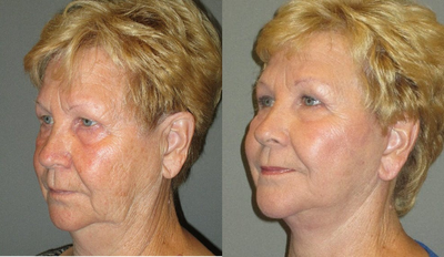 65-74 year old woman treated with SMAS Facelift - This lovely patient presented with the complaint that she looked tired and exhausted all of the time. After full consultation together we decided that she would most benefit from a lower facelift/necklift. The procedure was safely performed in our office under local anesthesia and oral sedation with valium. The results are quite natural, and she felt that she looked over ten years younger after the procedure.