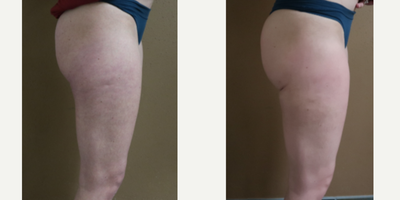 35-44 year old woman treated with Liposuction - 35-44 year old woman treated with Liposuction for contouring of banana roll below buttocks area for better definition, shown 6 months post op.