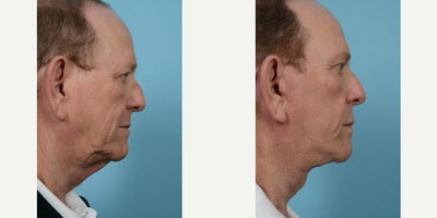 68 year old man treated with Neck Lift, Eyelid Surgery, Brow Lift, Deep Plane Facelift - 68 year old man treated with Neck Lift, Eyelid Surgery, Brow Lift, Deep Plane Facelift