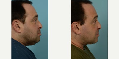 50 year old man treated with Neck Lift - 50 year old man treated with Neck Lift