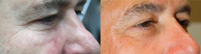 55-64 year old man treated with MiXto Laser - With this treatment, you can achieve lifting and tightening of the skin around the eyes equivalent to and more natural than eyelid surgery with a fraction of the downtime. This amazing laser addresses crows feet, loose skin and hooding and the results are truly astonishing.