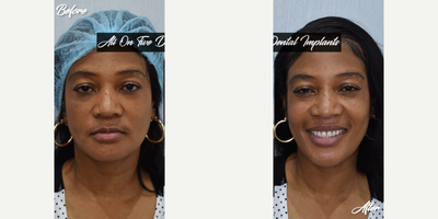 45-54 year old woman treated with All-on-4 Dental Implants, Dental Implants, Dental Bone Graft, Smile Makeover, Botox - This patient wanted to have her teeth fixed.