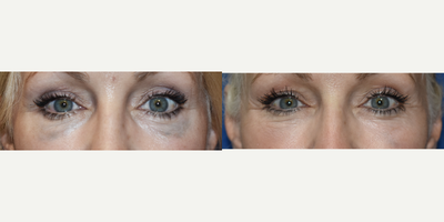 Blue Scars under the eyes after injection of foreign body. - Scar Treatments can be pretty much anything. This patient had a foreign body injected under here eyes (she was not sure what) and it turned blue. This issue often arises when a material placed in the body has iron particles in it. The change is color is called oxidization and our tattoo removal laser fixed the problem in one treatment!